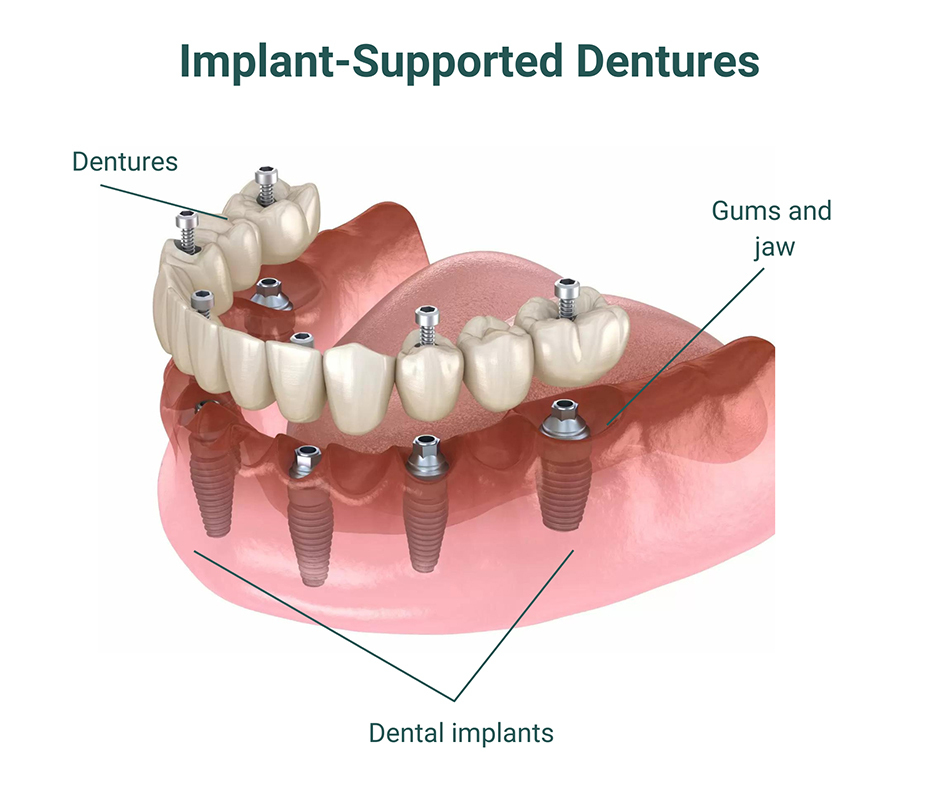 The Complete Guide To Dental Implants For Full Dentures Healthy Teeth